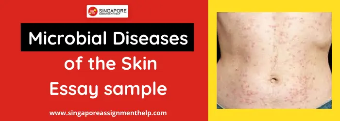 Microbial diseases of the skin essay